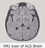 MRI scan of ALS brain