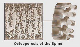 osteoporosis of the spine