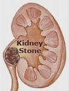 kidney stone