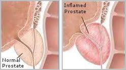 Normal versus inflamed prostate