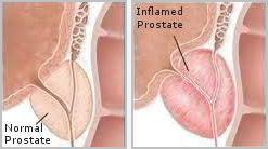 Tuyến tiền liệt bình thường so với viêm